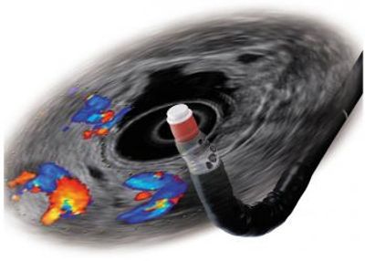 Obezite, Obezite Cerrahisi, Metabolik Cerrahi, Şeker Hastalığı, Tüp Mide,Mide Botoksu