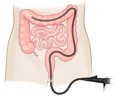 Obezite, Obezite Cerrahisi, Metabolik Cerrahi, Şeker Hastalığı, Tüp Mide,Mide Botoksu