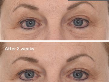  Murad deep peel before and after