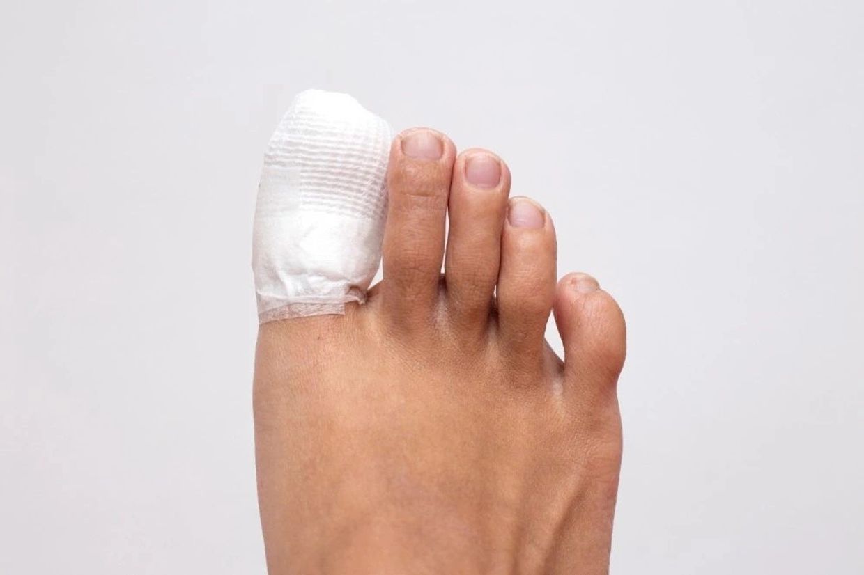 Nail surgery