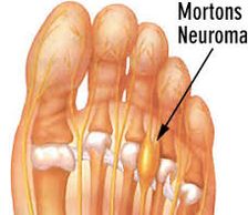 Ball of the Foot Pain, Mortons Neuroma, Neuroma, Neuroma Surgery, Collagen Shots Feet, Botox Shots 