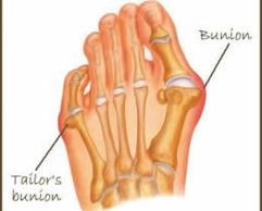 Bunion, Bunions, Bunion Pain, Curled Pinky Toes, Pinky Toe Pain, Stiff Big Toes, Bunion Surgery