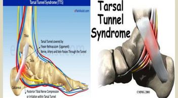 Ankle Pain, Ankle Repair, Sprained Ankle, Rolled Ankle, Tarsal Tunnel Sydrome, Tarsal Tunnel 