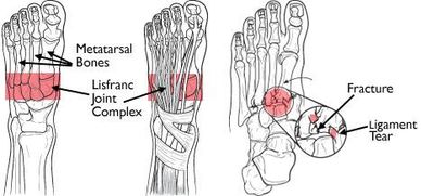 Midfoot Injury, Lisfranc Injury, Lisfranc Fracture, Sprained Ankle, Rolled Ankle, Ankle Pain