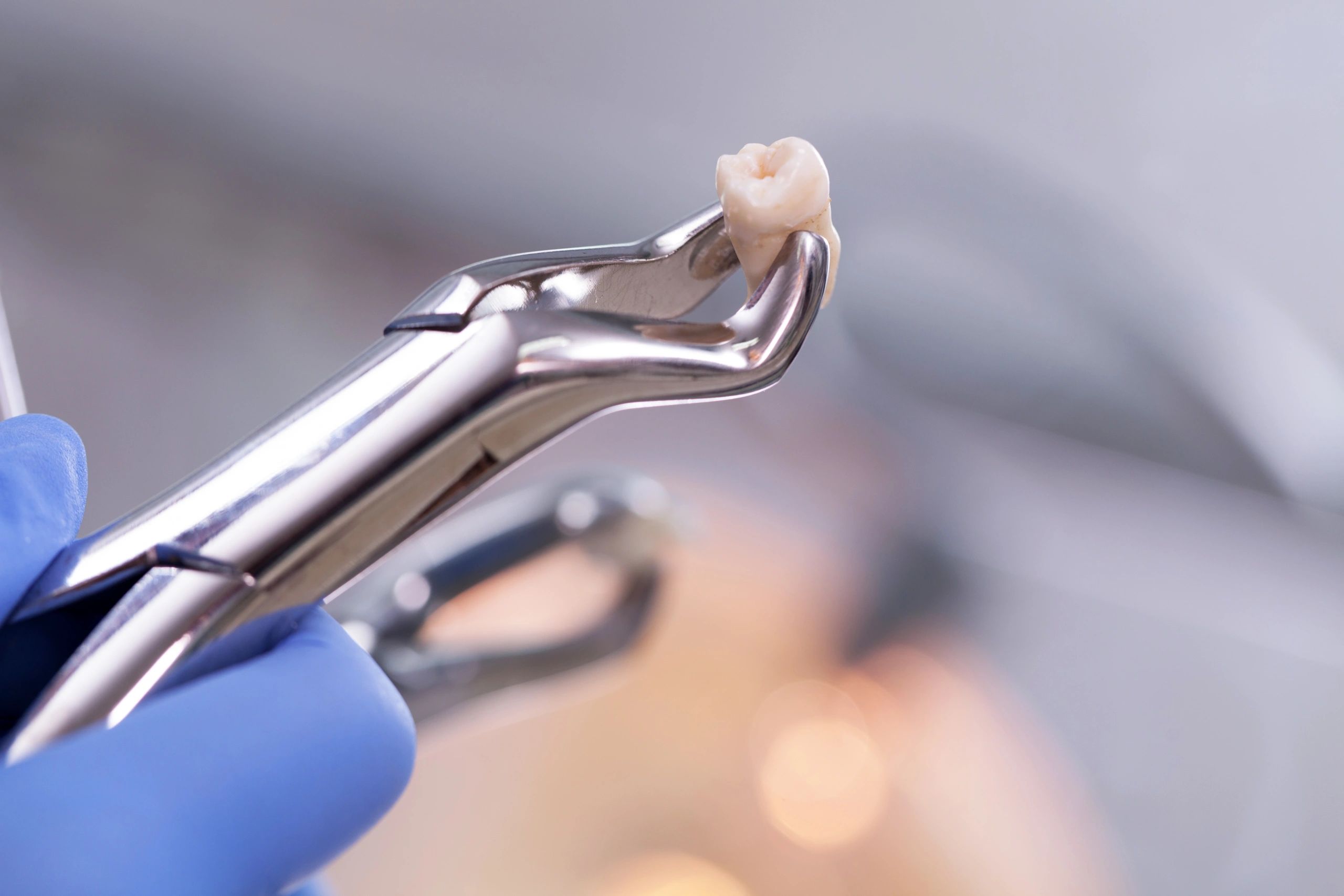 Tooth Extractions in Indianapolis, Indiana | 7 Days Family Dental 