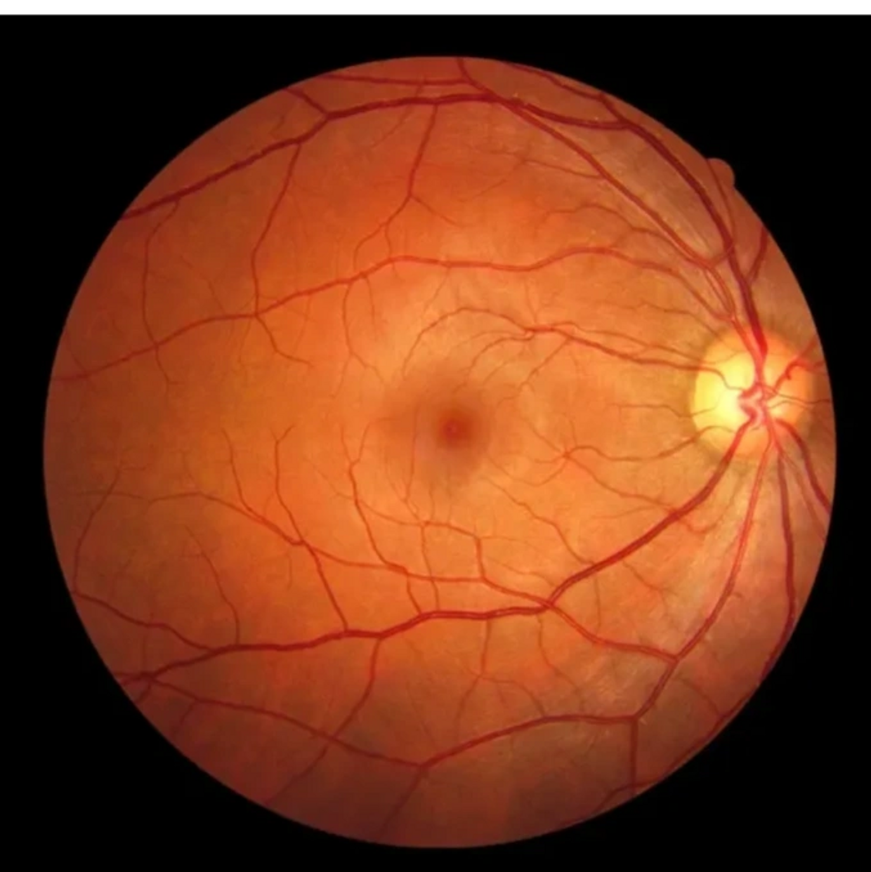 retina diabetic retinopathy 