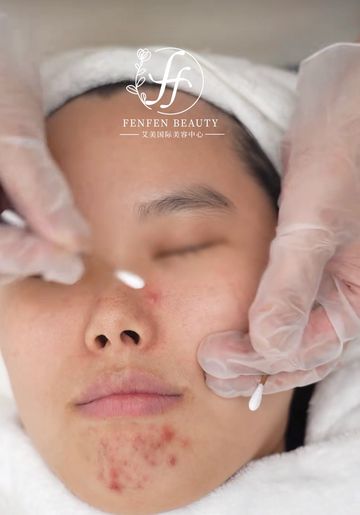 Acne facial use products specific ingredients to target acne bacteria.