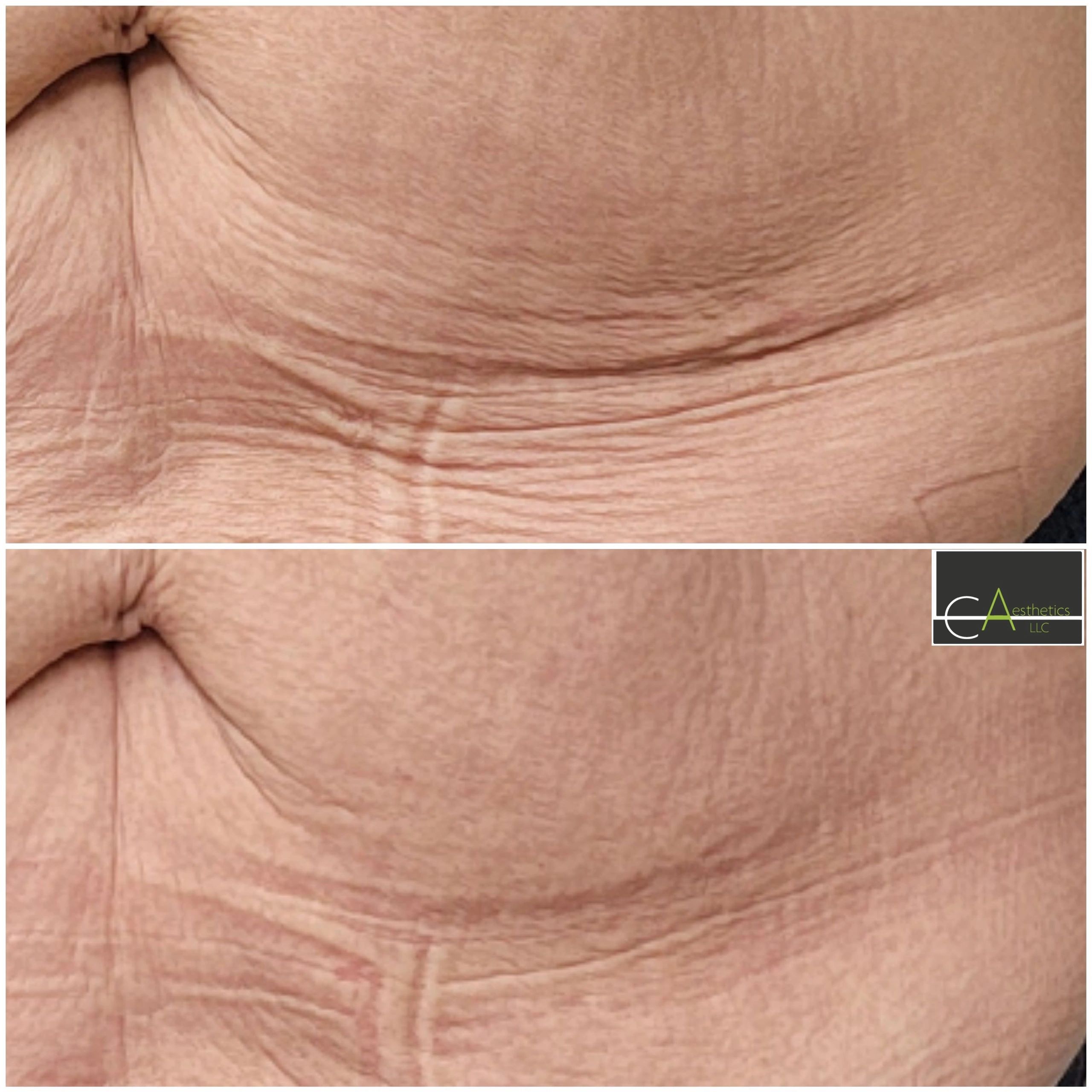 Abdominal Skin Flap Apron