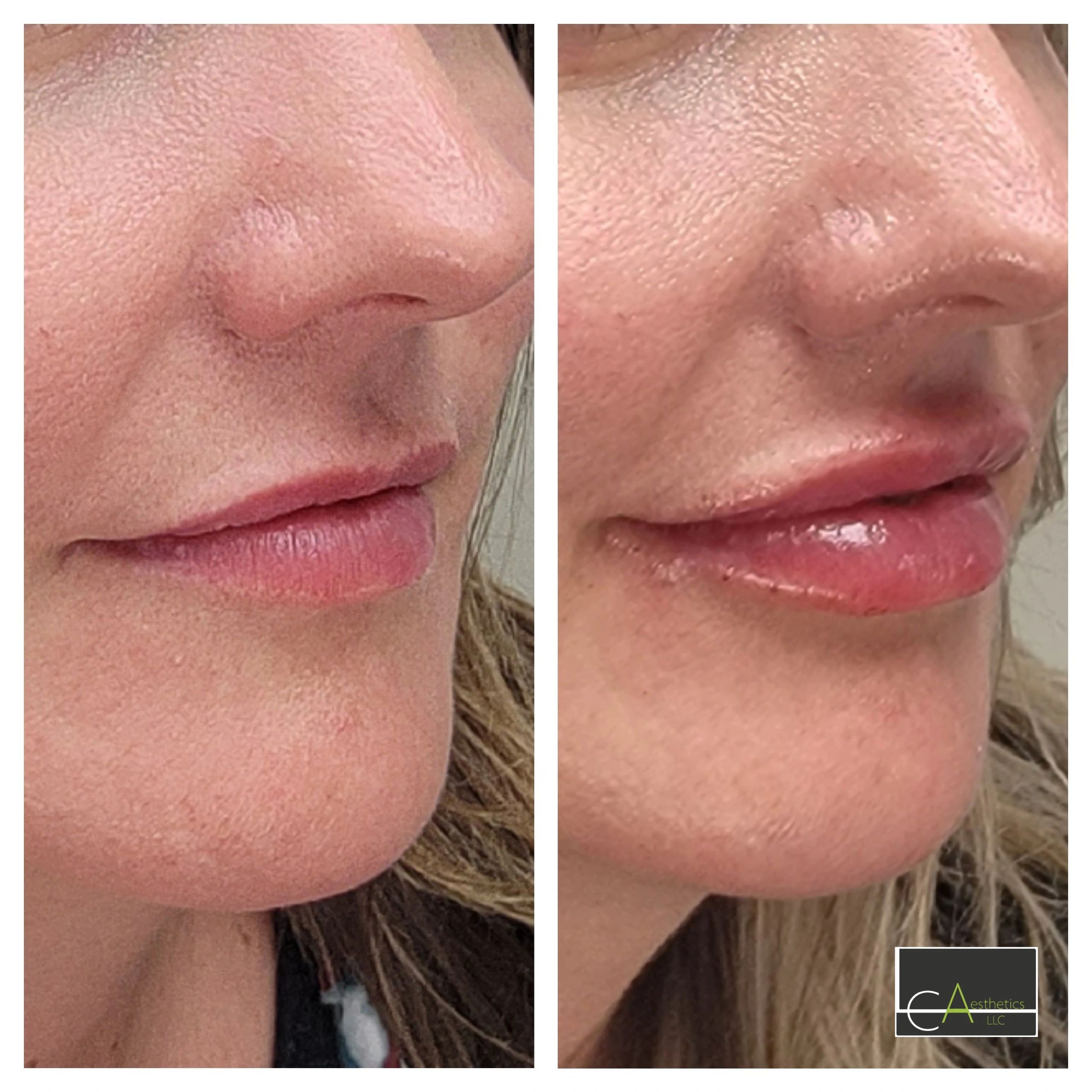 Best Lip Filler Explained