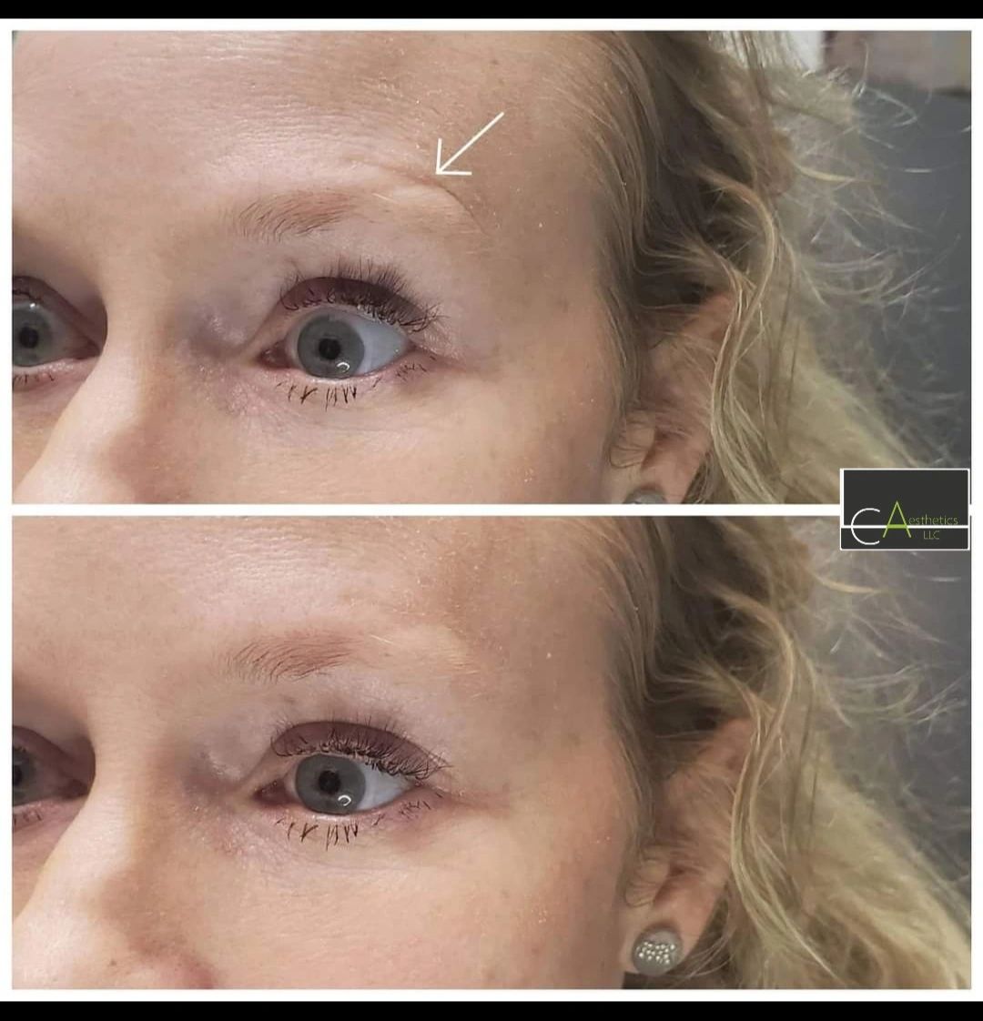 Thread Scar Treatment