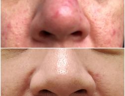 Before and After Photos - Rosacea Treatment - Lake Country Aesthetics Procedures In Hartland, WI