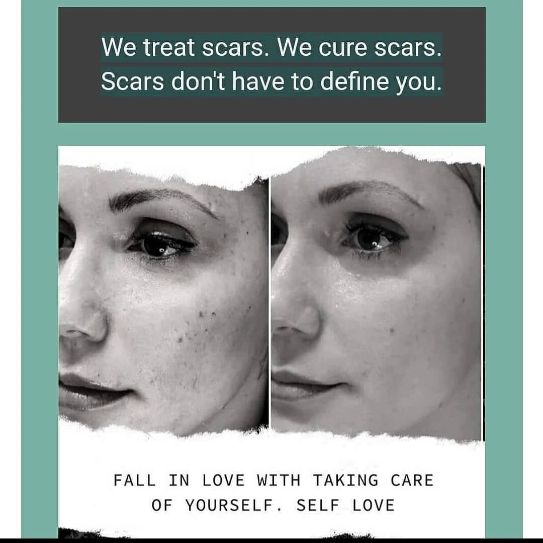 Scars