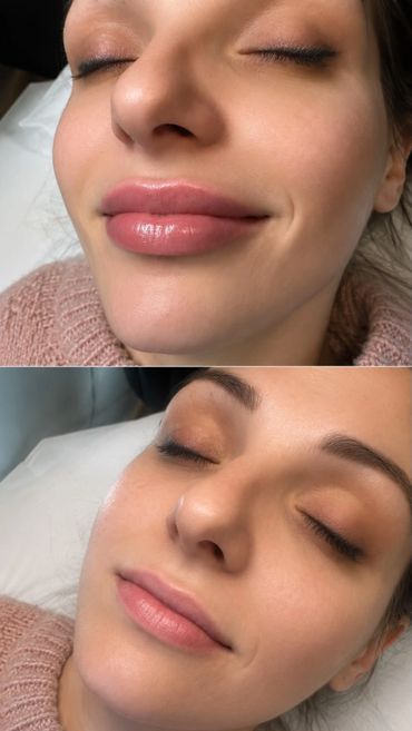 Close-up before and after photos of a woman's face showing lip enhancement results.