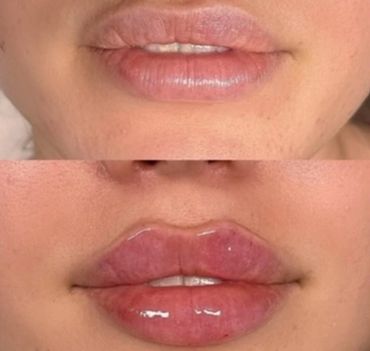Close-up of lips before and after glossy lip enhancement.