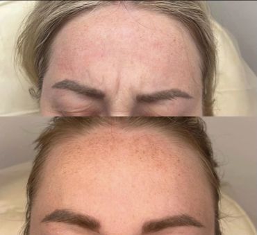 Before and after images of a woman's forehead showing smoother skin after treatment.