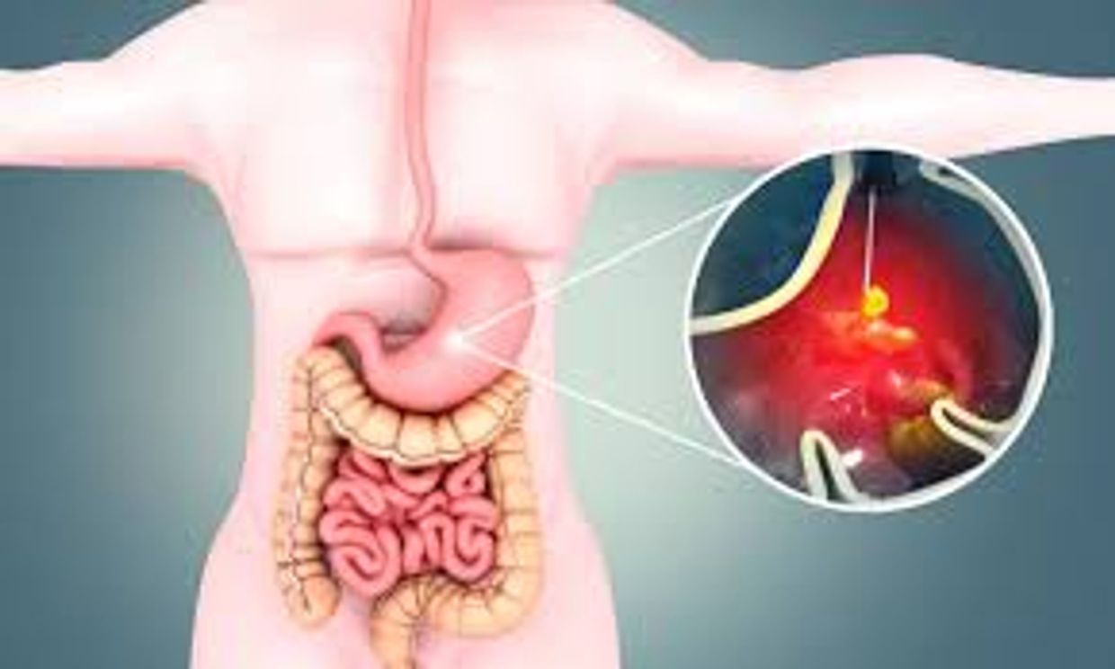 stomach Ulcer