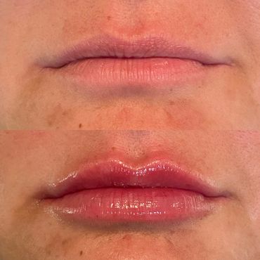 Lip augmentation, lip filler before and after