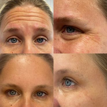 Product used: Xeomin, After photos taken two weeks after initial treatment