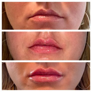 before and after lip filler progression; from no filler to 0.5 mL Restylane Kysse, to 1 mL Restylane