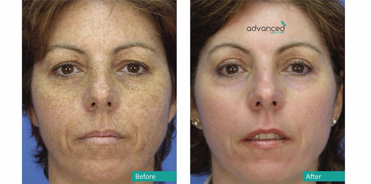 Sciton Micro Laser Peel - Advanced Skin Care - Southlake, Texas