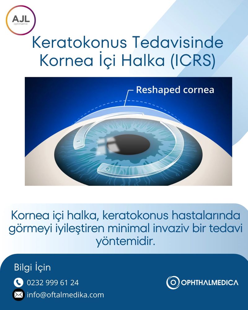 ICRS, keratokonus halkası, korneal halka