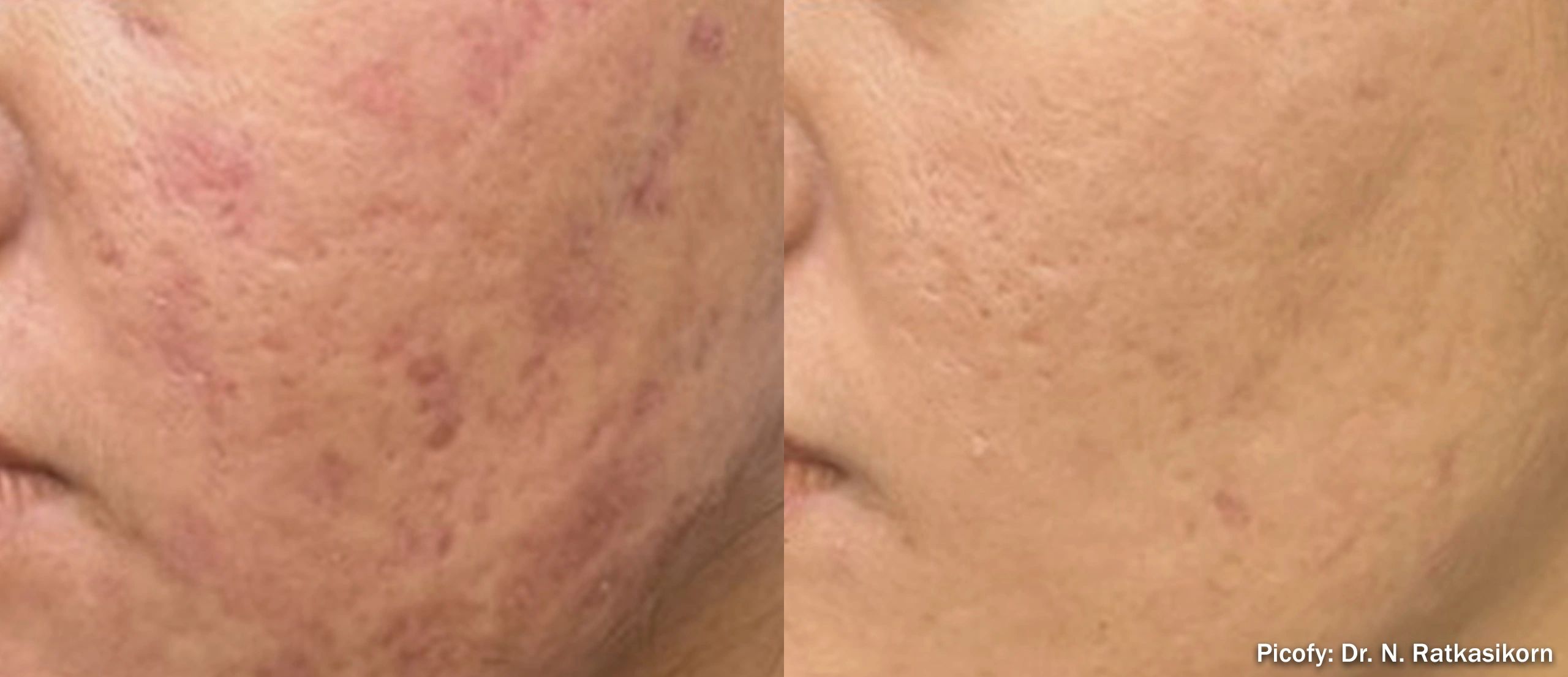 Before and after acne scar treatment on cheek.