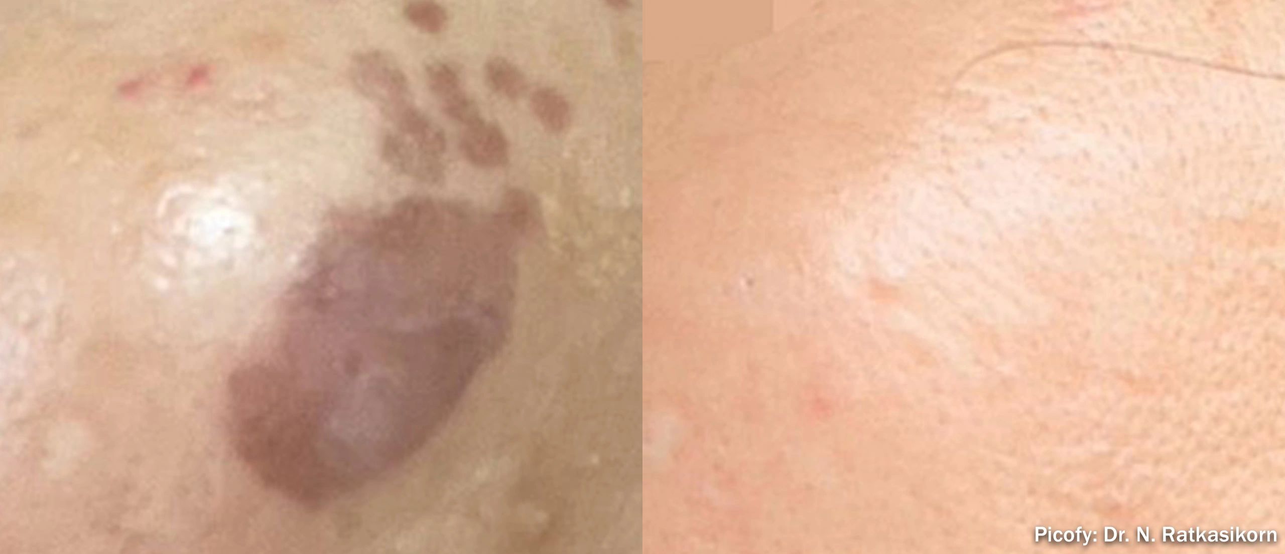 Close-up of a skin condition with pigmentation changes.