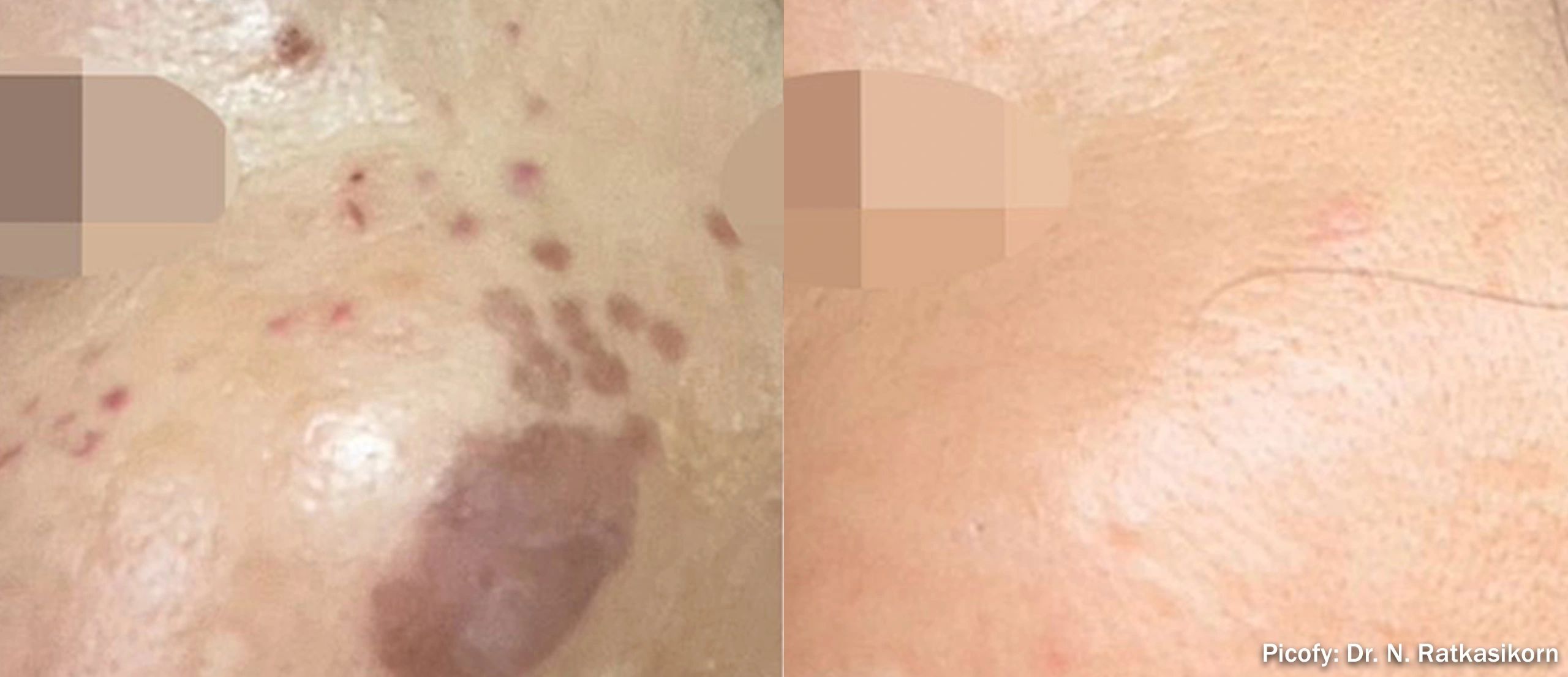 Before and after treatment of dark spots on skin.
