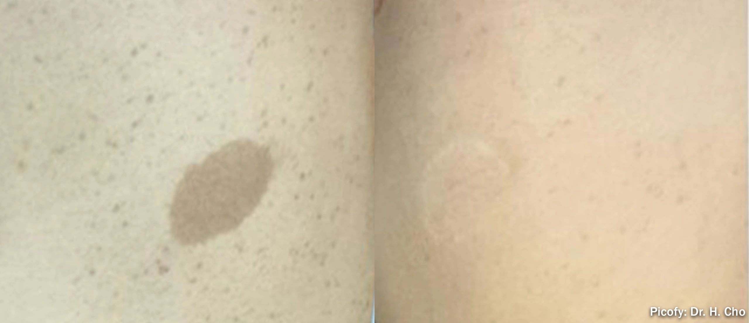 Skin condition showing light and dark patches.