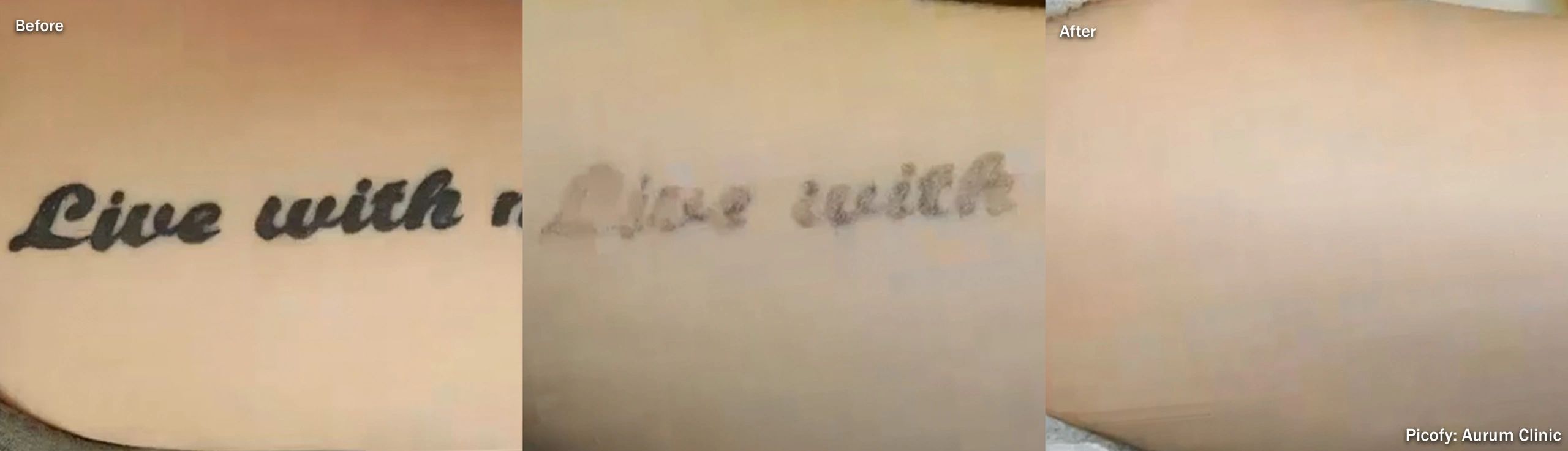 Tattoo removal process in three stages: before, during, after.