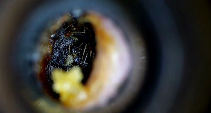 Ear before microsuction — example 1