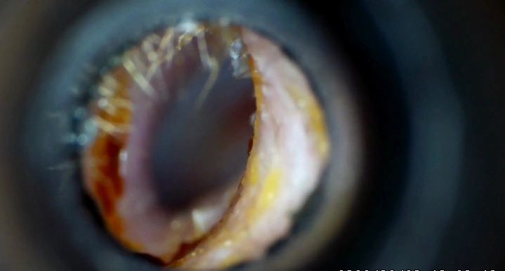 Ear after microsuction — example 1