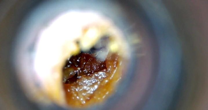 Ear before microsuction — example 2