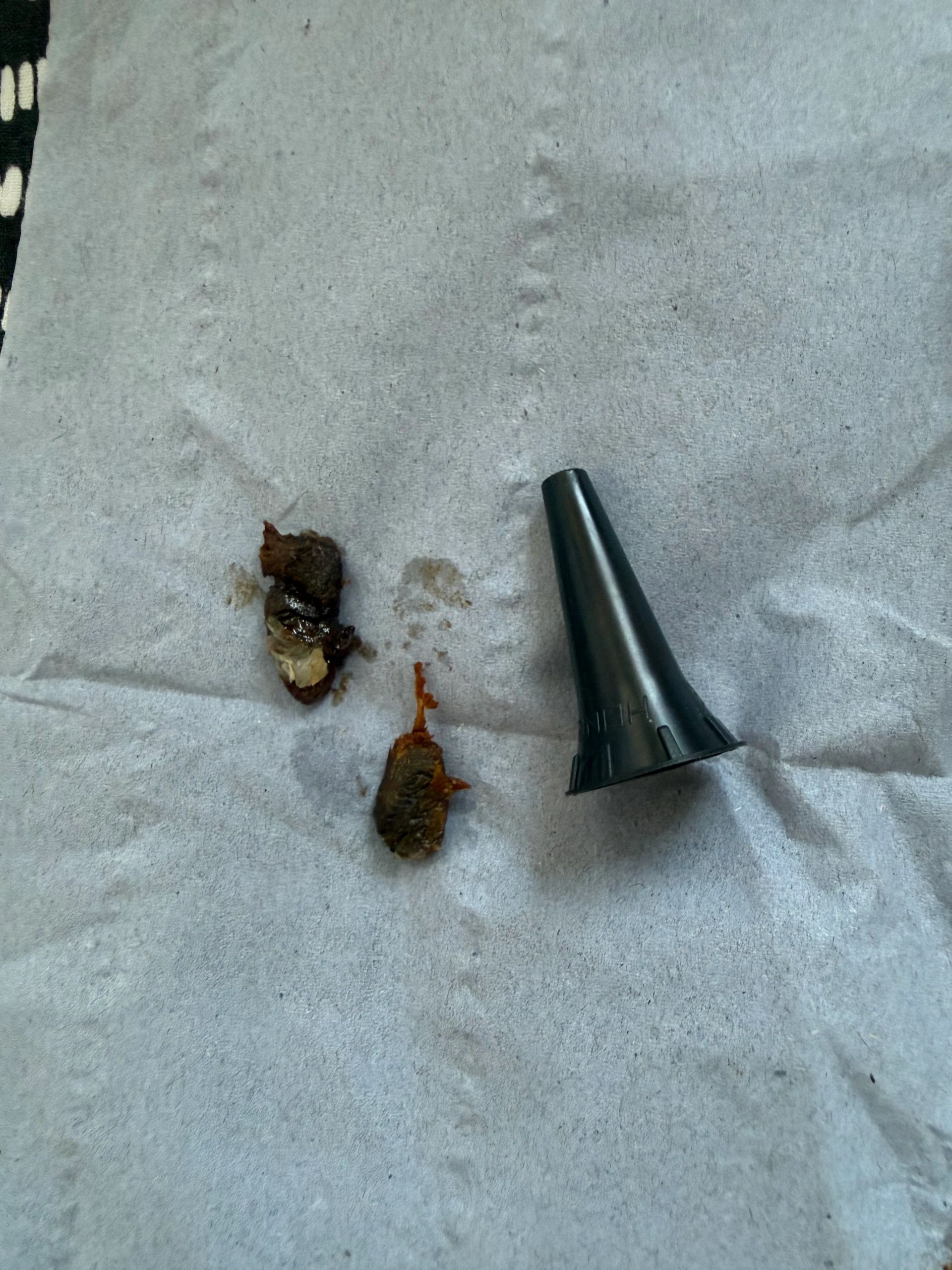 Ear wax removal result — example 3