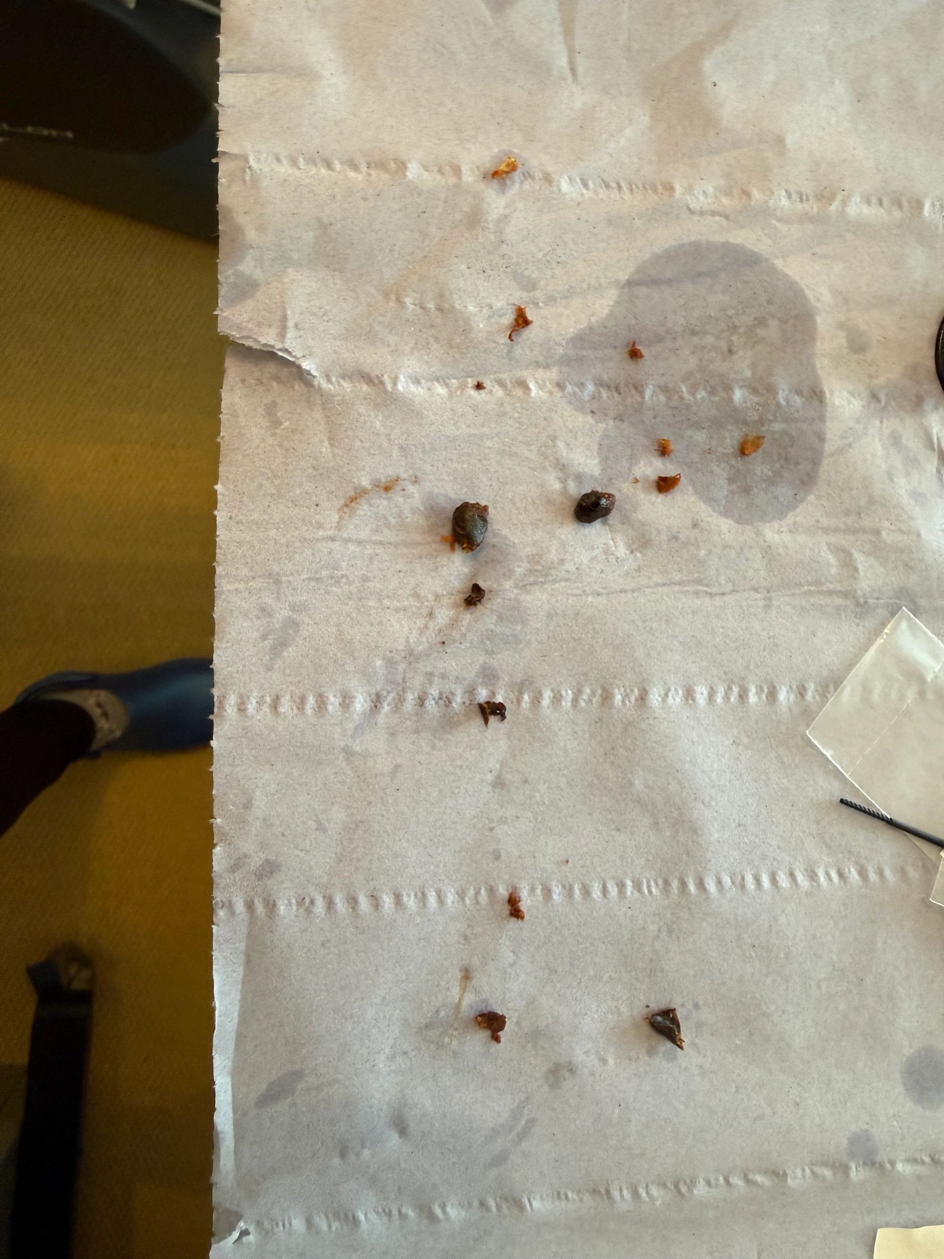 Ear wax removal result — example 7