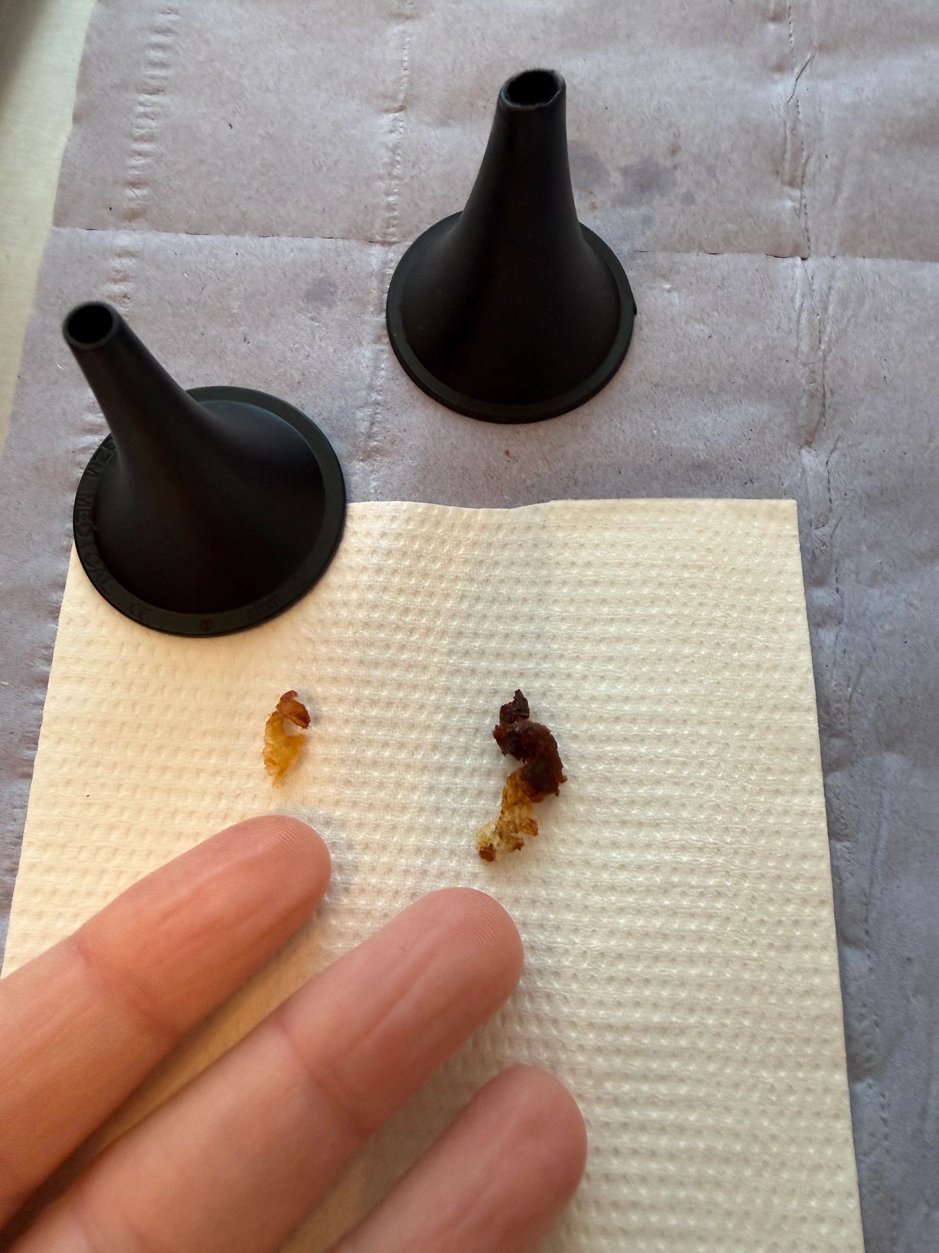 Ear wax removal result — example 4