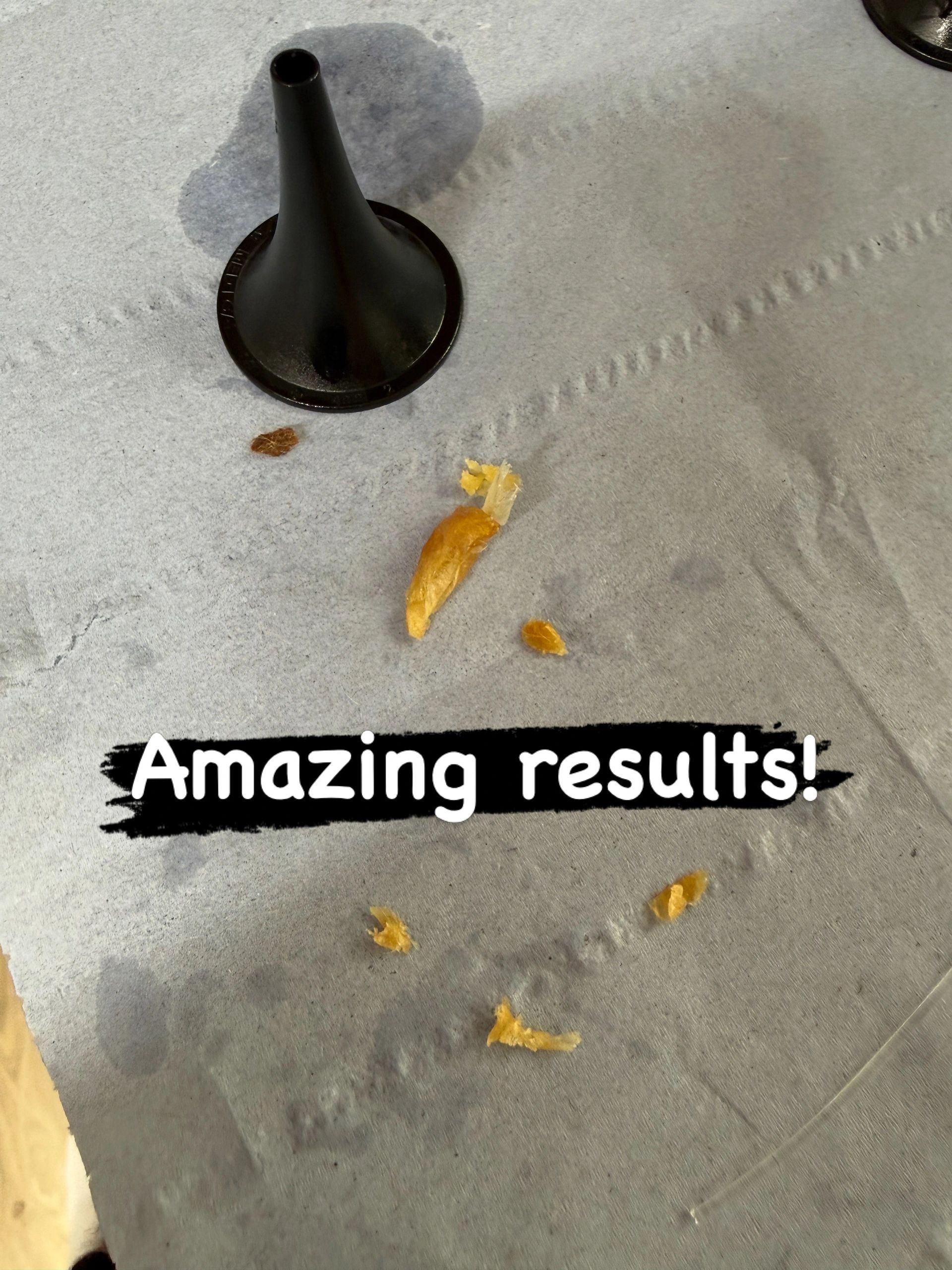 Ear wax removal result — example 6