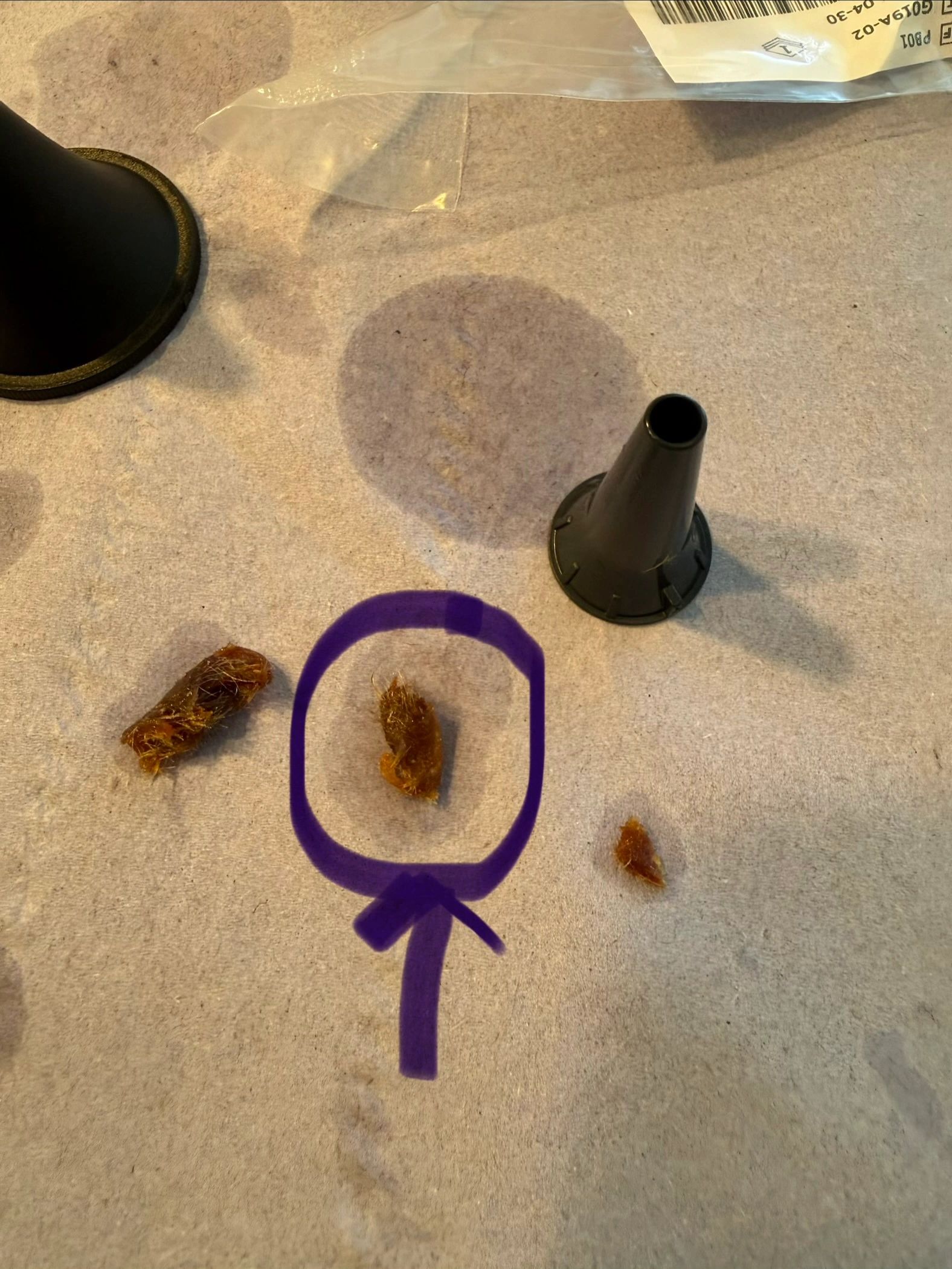 Ear wax removal result — example 5