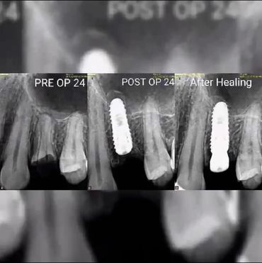 Dental implant treatment case with before and after X-ray results