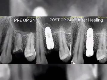 Dental X-rays showing pre-op, post-op, and healing stages of a dental implant.