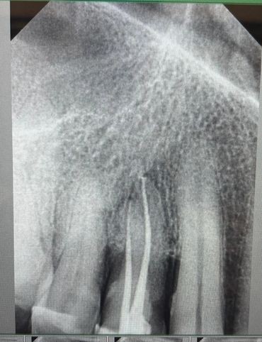 Digital dental X-ray used for accurate root canal diagnosis and treatment planning