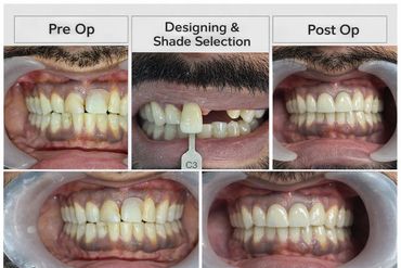 Smile makeover and cosmetic dental treatment results at Vedanta Smiles