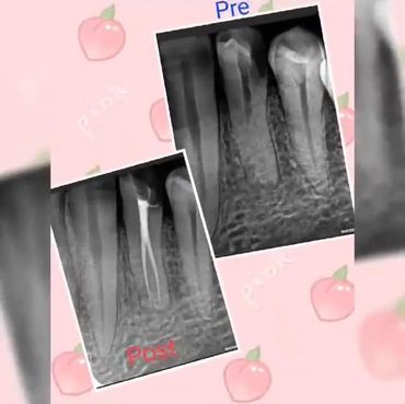 Root canal treatment X-ray showing infected tooth treatment at Vedanta Smiles Gurgaon