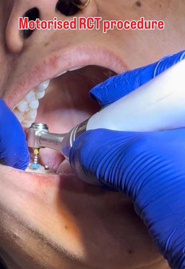 Motorised RCT Procedure