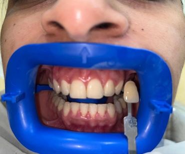 Patient showing a confident smile following cosmetic dental care.