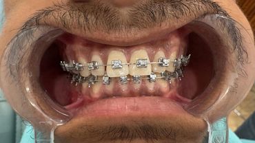 Happy patient showing their smile after orthodontic treatment with braces.