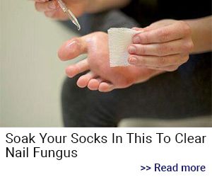 Nail Fungus Home Remedy