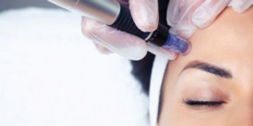 Microneedling treatment being performed on the forehead
