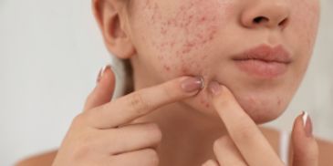 Close-up of acne-prone facial skin