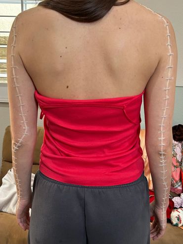 Prosthetics on the back of the arm that makes it appear stapled shut before they have been painted